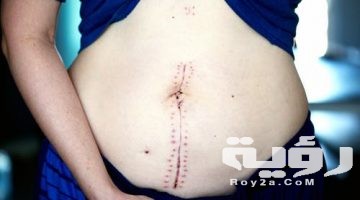 تفسير رؤية خياطة الجرح في المنام