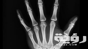 تفسير رؤية مرض هشاشة العظام في المنام