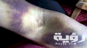 تفسير رؤية كدمات زرقاء في المنام