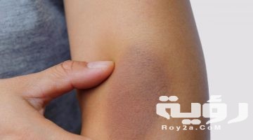 تفسير رؤية كدمات في الجسم في المنام