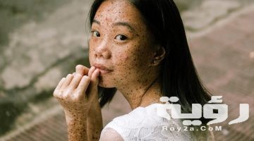 تفسير رؤية مرض الحصبة في المنام