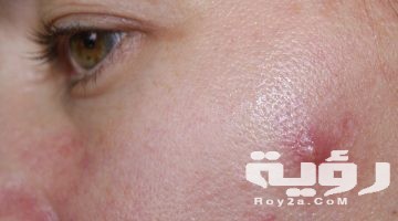 تفسير رؤية ظهور الحبوب في المنام