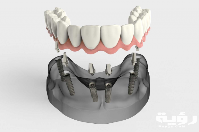 Implant Supported Prosthesis Locust NC
