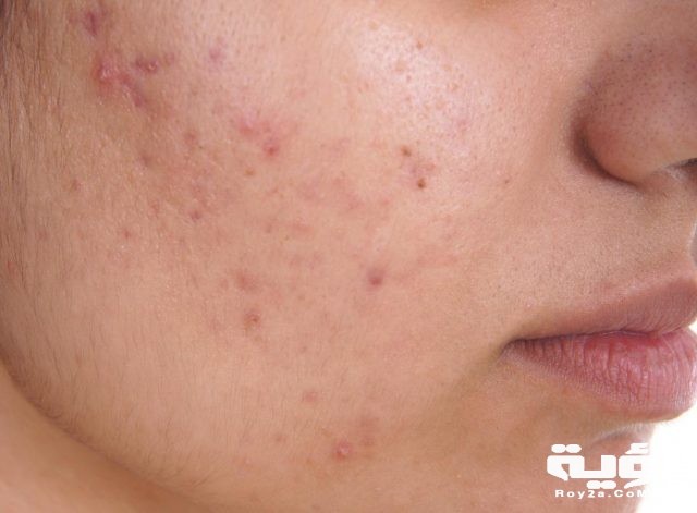 acne