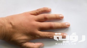 تفسير رؤية اليد المتورمة في المنام