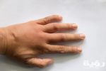 تفسير رؤية اليد المتورمة في المنام 1 swollen and puffy hand scaled