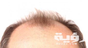 تفسير رؤية الصلع في المنام
