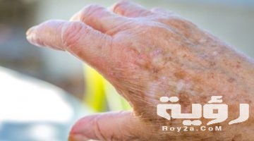 تفسير رؤية اثار حروق في الجسم في المنام
