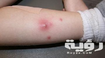 تفسير رؤية الدمامل في المنام