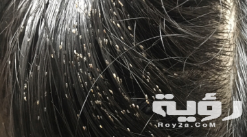 حلمت اني ينزل من شعري قمل