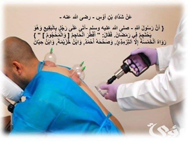 هل الحجامة مشروعة فالاسلام