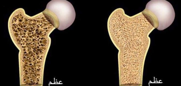 اذاعة مدرسية عن هشاشة العظام : مع مقدمة وخاتمة 1 اذاعة مدرسية عن هشاشة العظام