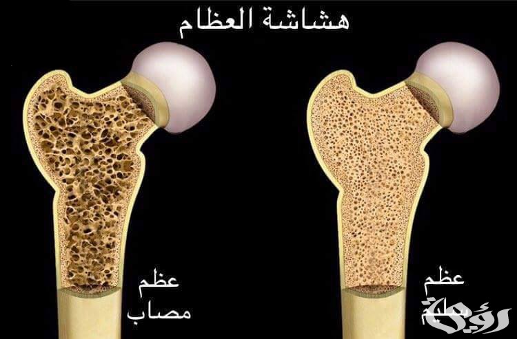 اذاعة مدرسية عن هشاشة العظام : مع مقدمة وخاتمة