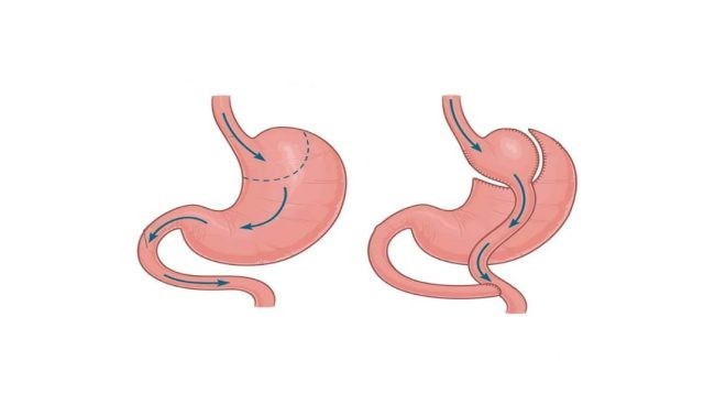 تكلفة عملية تحويل مسار المعدة في الكويت تكلفة عملية تحويل مسار المعدة في الكويت
