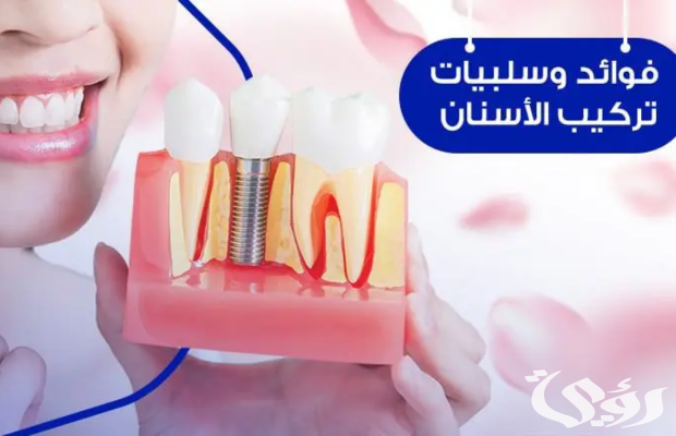 تكلفة زراعة الأسنان في الأردن مع التجارب تكلفة زراعة الأسنان في الأردن مع التجارب