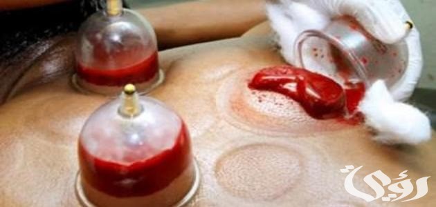 “التأهيل طبي” الحجامة تحسّن الدورة الدموية للمريض وتنشط الخلايا